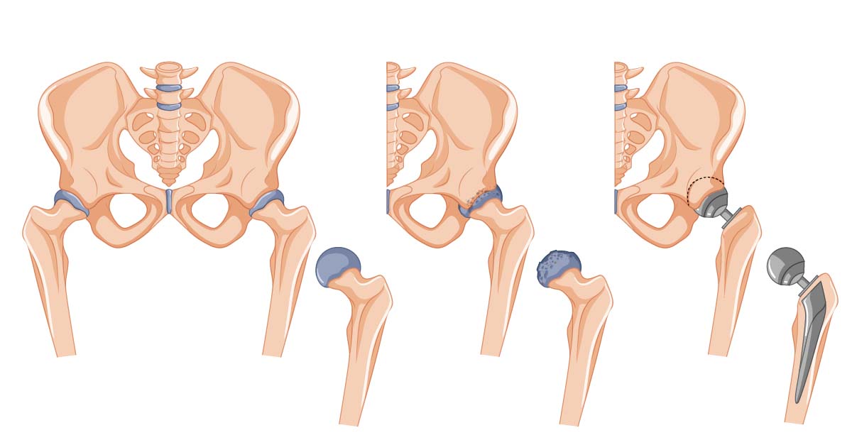 Hip Replacement Surgery How It Works And Treatment Options 7134