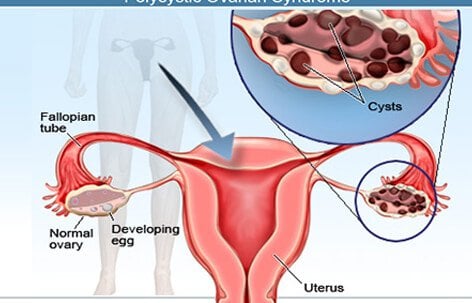 Ovarian Cysts Surgery  Symptoms and Treatment